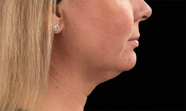 double chin under chin treatment coolsculpting nyc manhattan